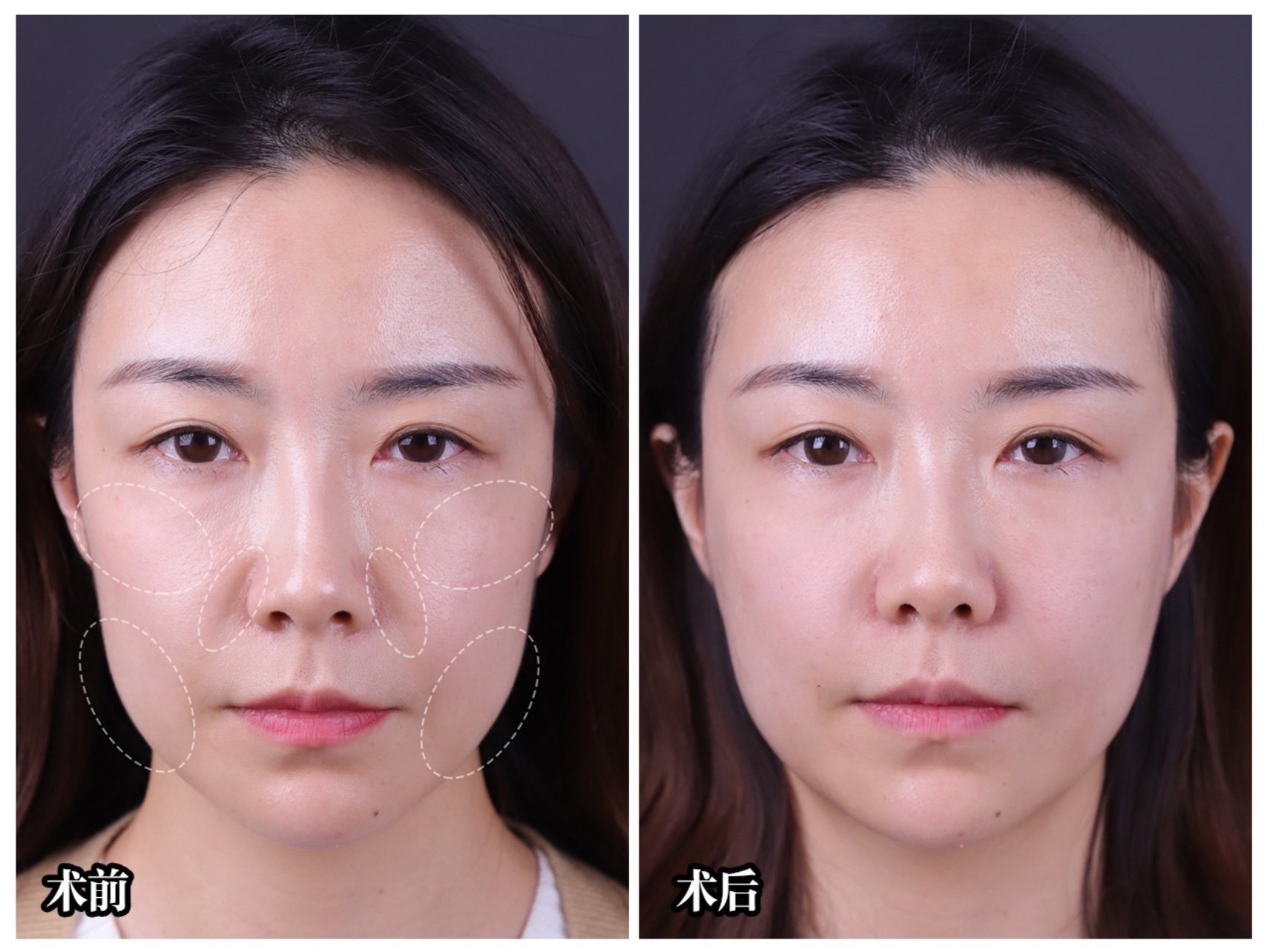 玻尿酸充填物的受欢迎原因和优势是什么?可以正常洗脸化妆吗?