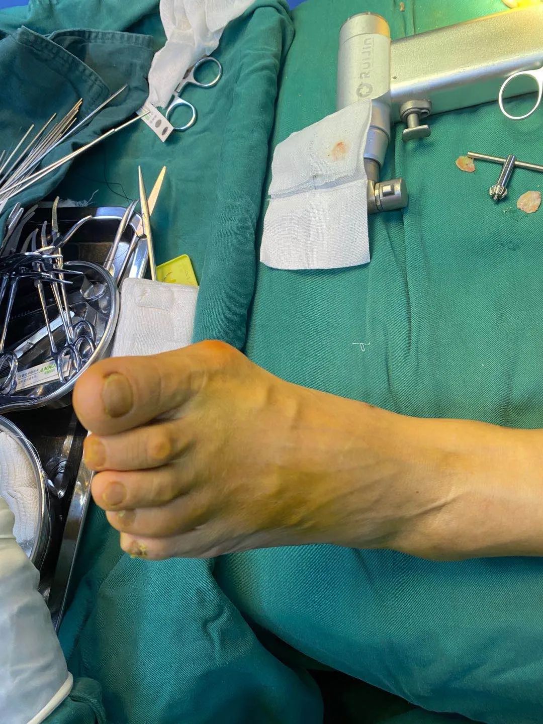 夏天不敢露脚趾?拇外翻微创手术:小切口解决大问题!