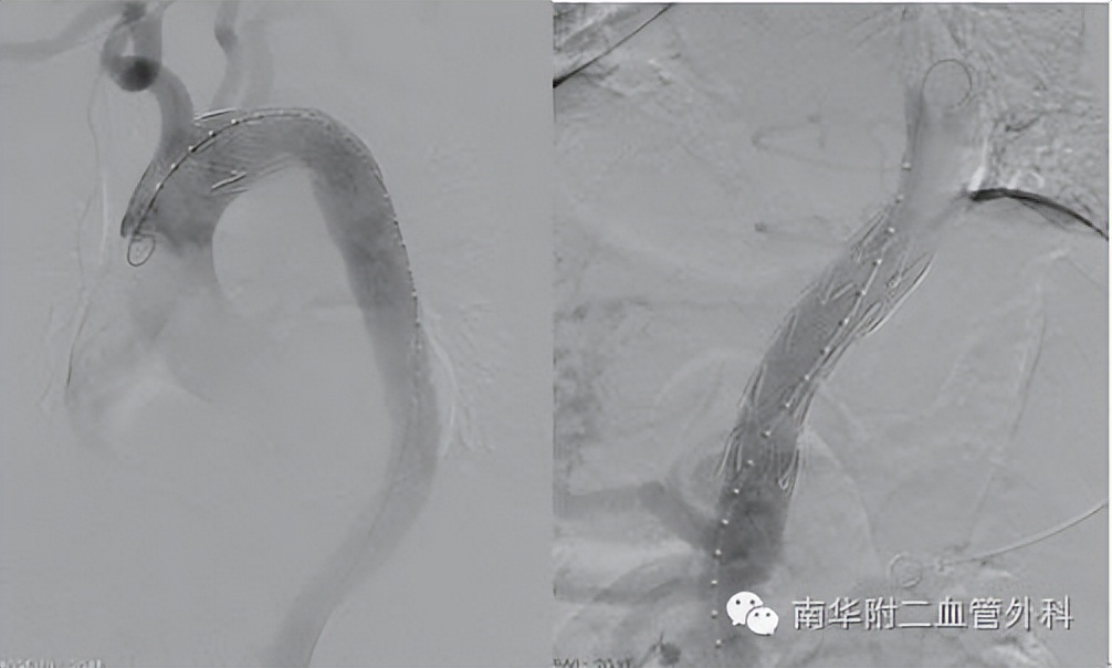 主动脉也会"溃疡"