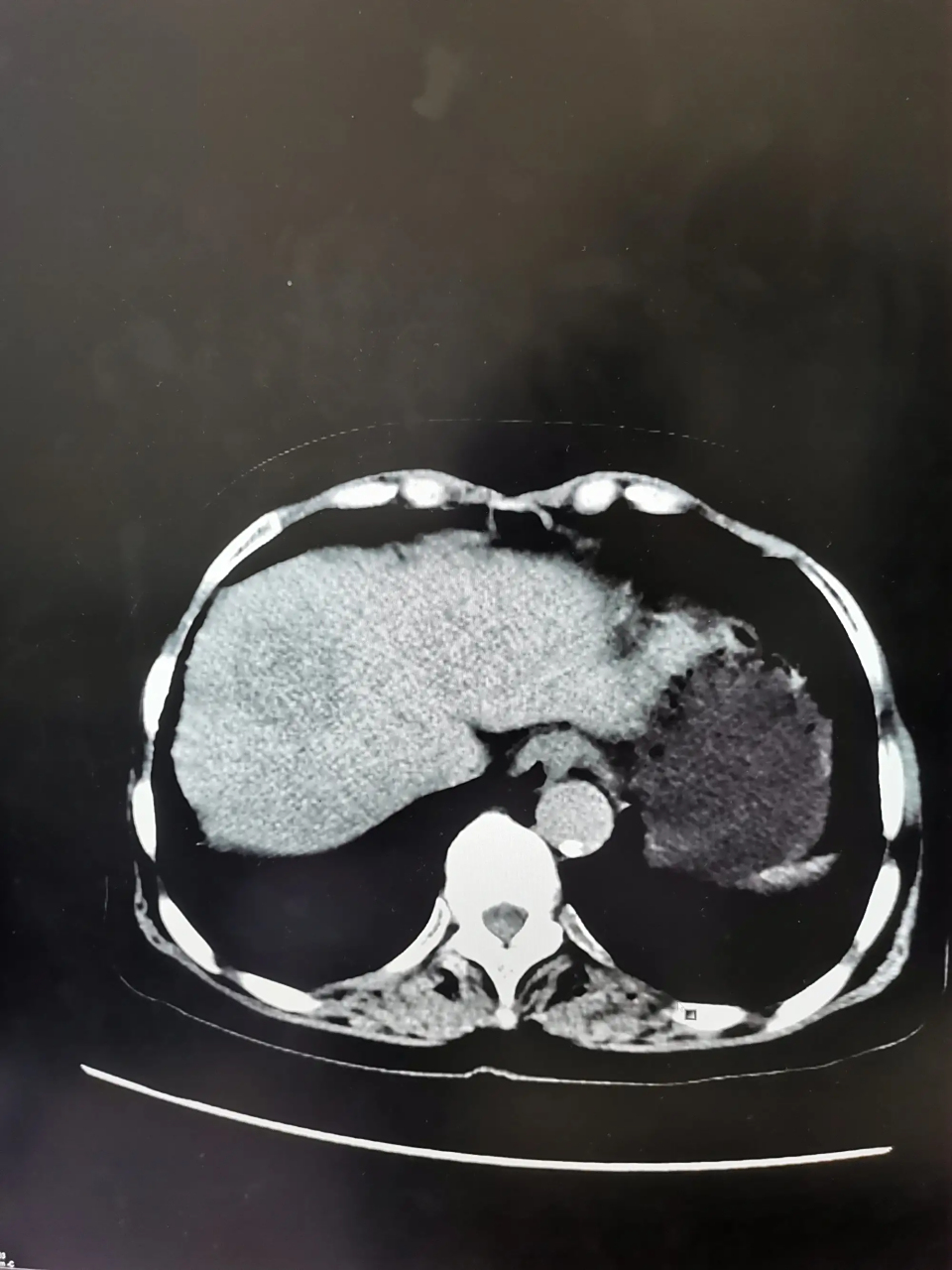 今天在下楼买东西遇到一个人,神经兮兮的,一看见我就说我得了肝癌,我