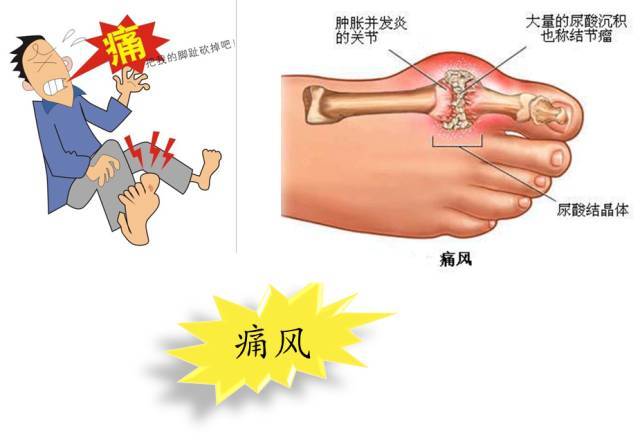 尿酸高的图片那么可怕图片