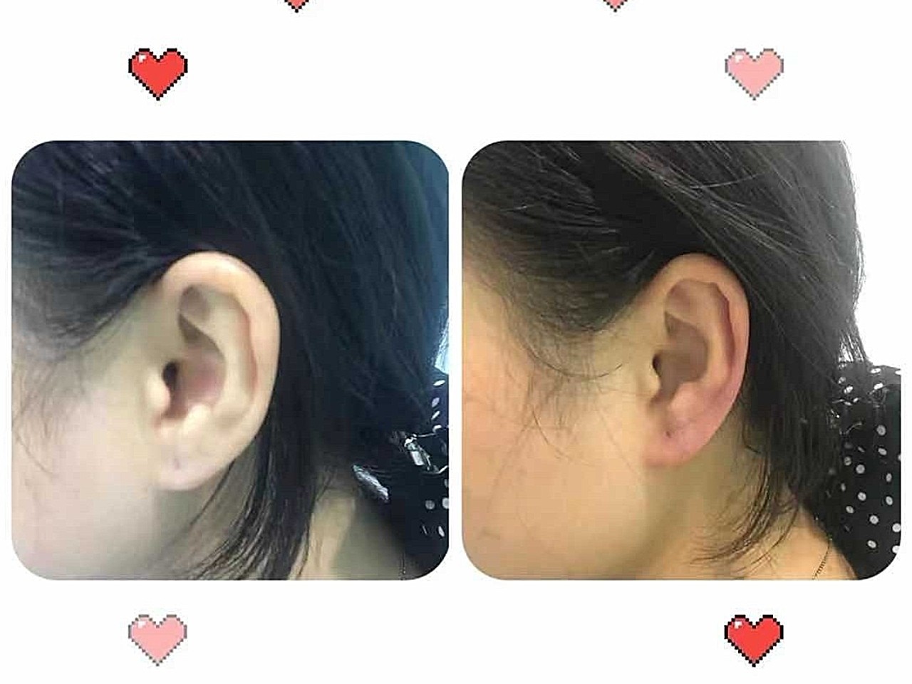 耳垂填充要注意哪些事项?