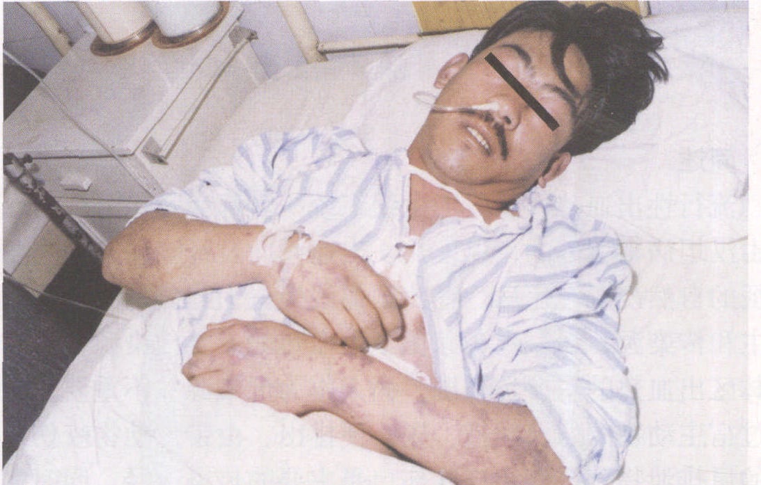 56年上海传染病院来一老农,浑身滚烫口鼻冒血,医生检查表情诡异