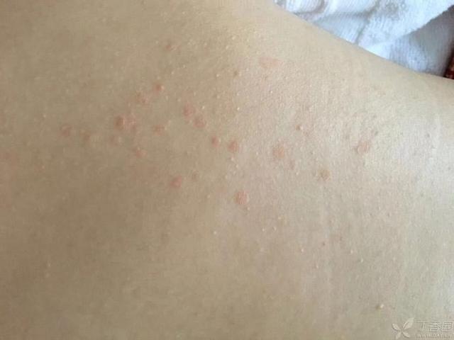 "螨虫的天敌"是什么?不是暴晒,教你个"蠢方法",螨虫消失了