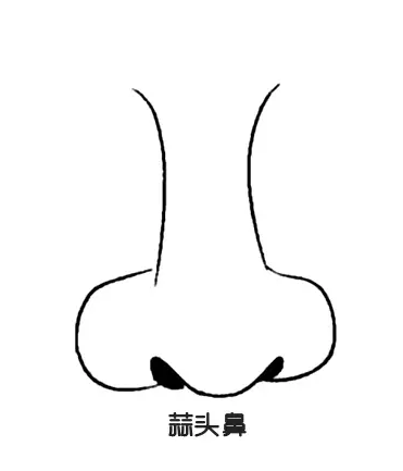 沃尔刘彦军分析鹰钩鼻,蒜头鼻矫正及术式