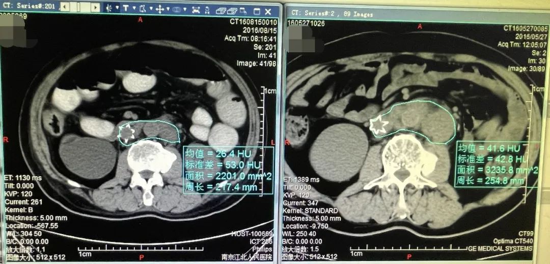 外放疗利用直线加速器或伽马射线源从体外对体内病灶进行照射;内放疗
