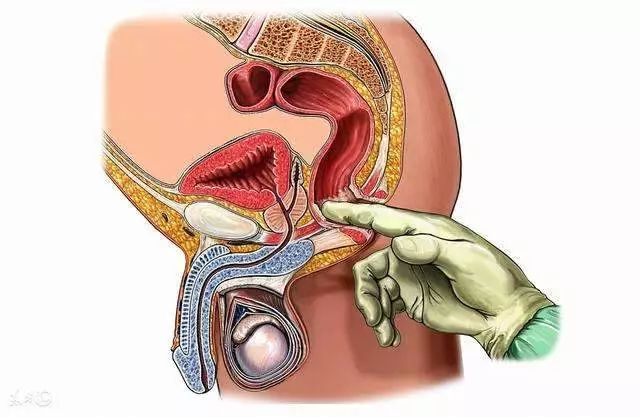 直肠指诊方法