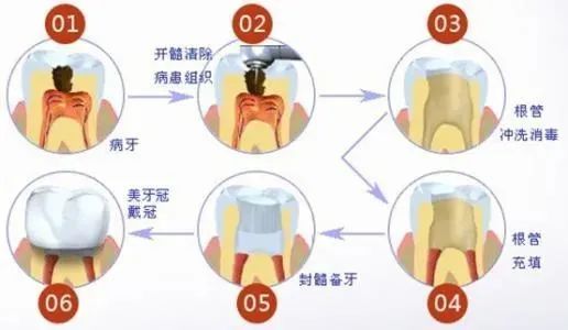 为什么根管治疗后医生总是劝我们要做冠