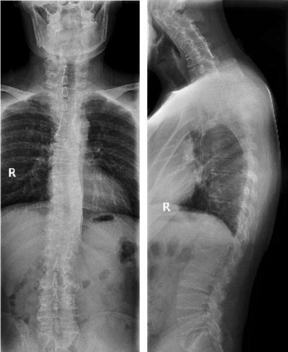 强直性脊柱炎x线表现图片