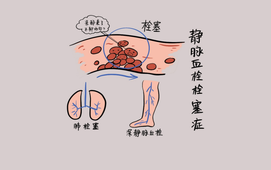 静脉输液空气栓塞图片图片