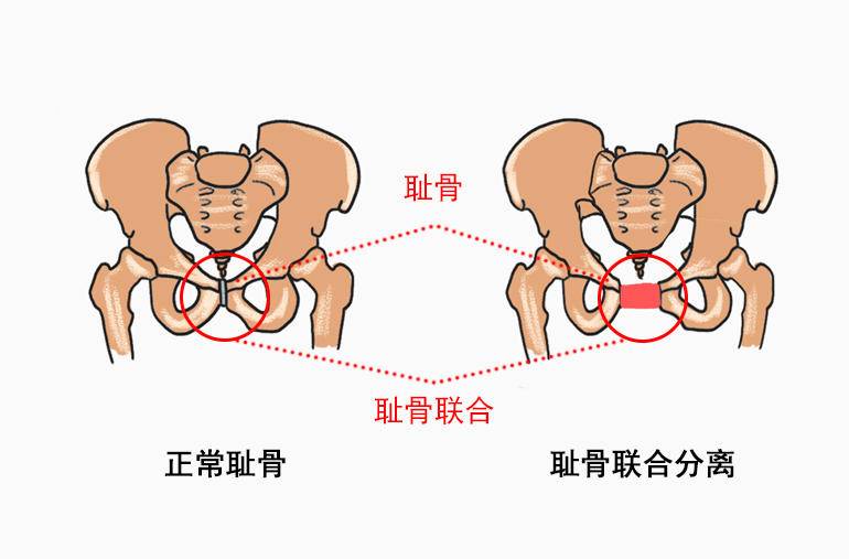 耻骨痛到底是哪里痛?孕期有四类孕妇容易被它找上门