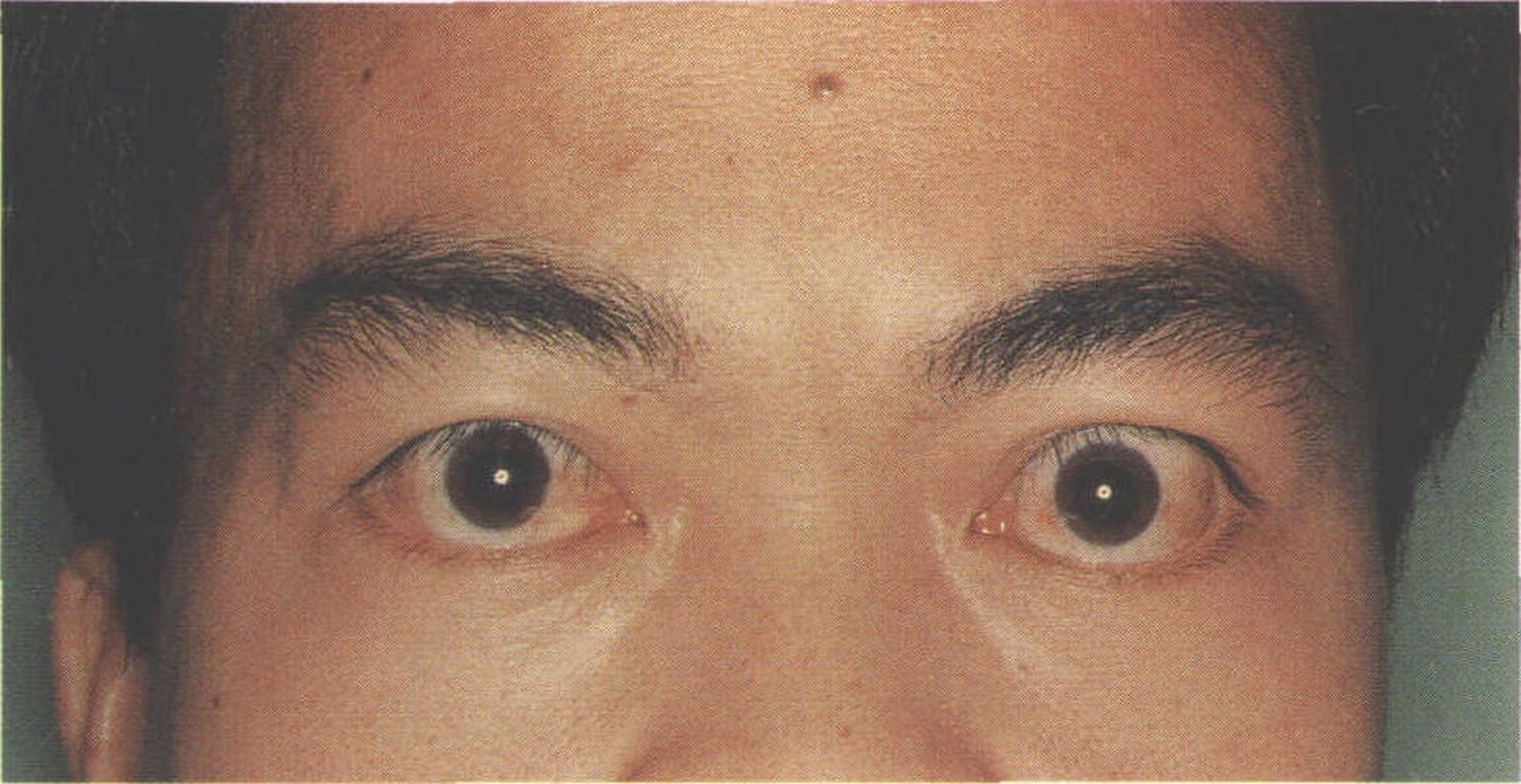1,甲亢突眼患者多为中度或重度进行性单侧或双侧突眼.