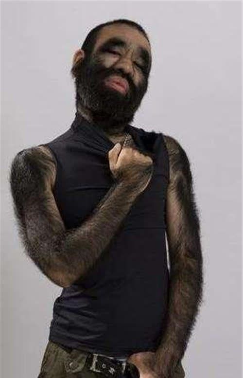 45年前毛孩出生成国宝工作因浑身是毛被辞41岁娶90后娇妻