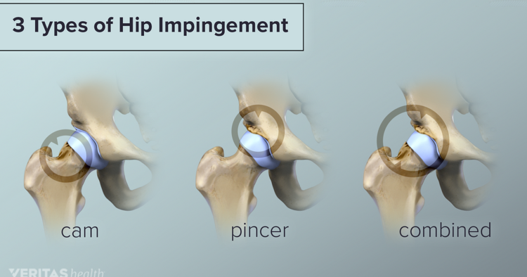 髋关节撞击hip impingement