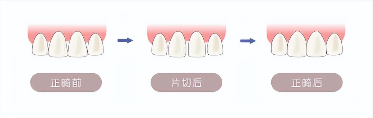 昆明正畸科普:牙齿片切会伤害牙齿吗?片切后该如何护理