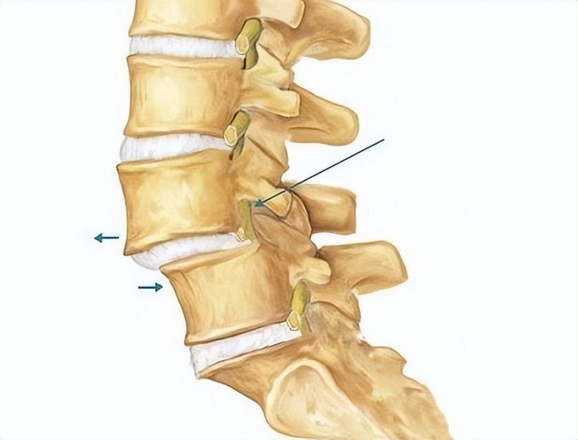 腰椎滑脱后
