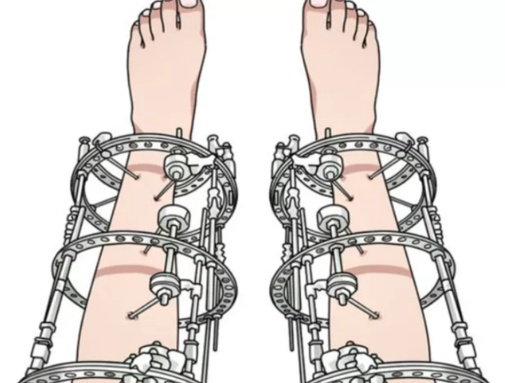 回顾只为长高7.2厘米,当年花16万断骨的李亚诺,如今与后遗症为伴