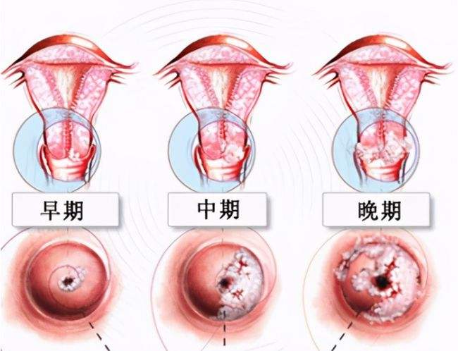 宫颈癌早期症状 表现图片