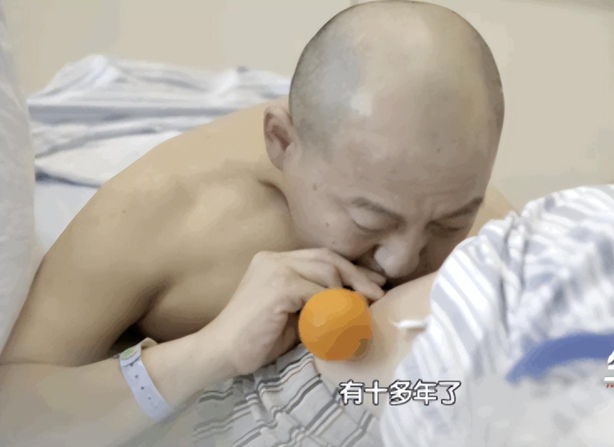 折叠人李华骨头被敲断4次植入22颗钢钉如今重获新生