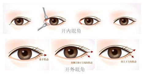 外眼角有必要开吗 baijiahao.baidu.com