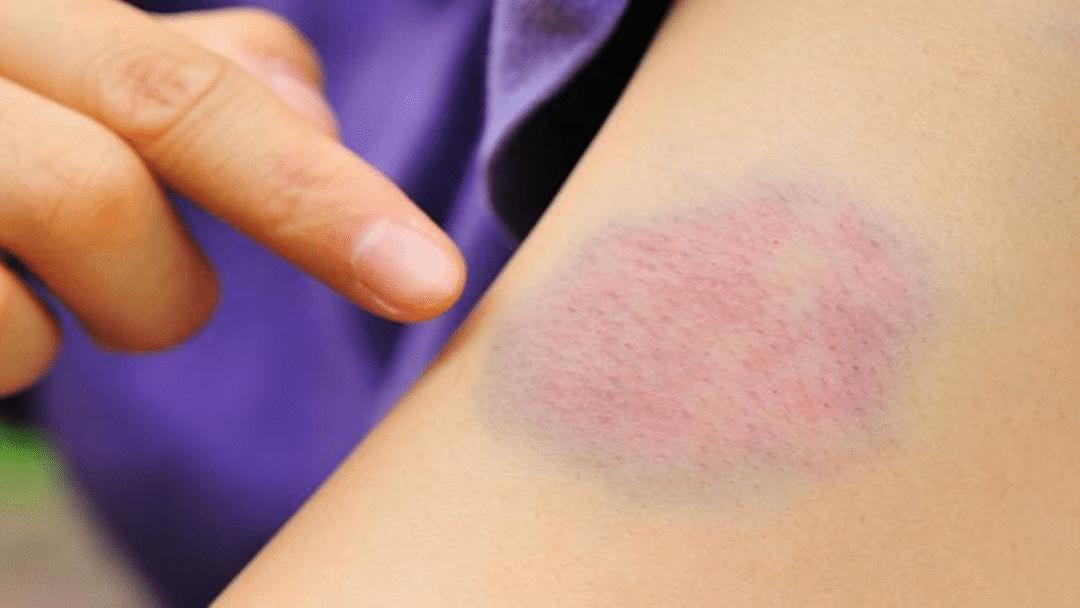 莫名出现淤青,5个原因,早了解