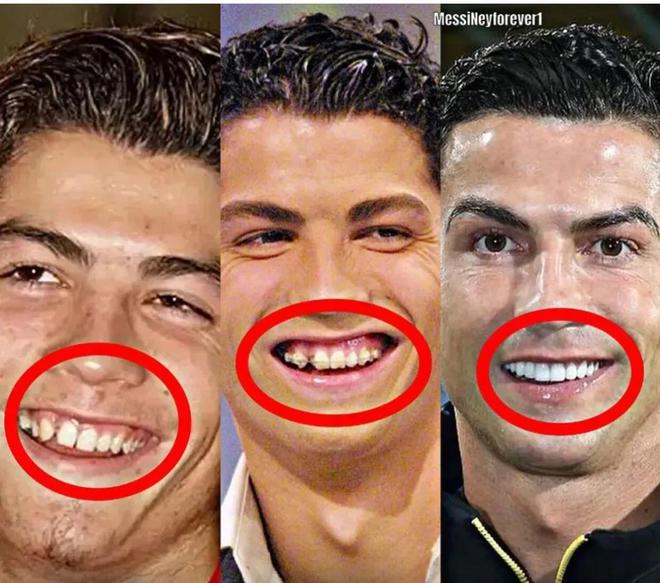 c罗:小时候是个龅牙少年,出名后感觉太丑,斥巨资6000英镑整牙