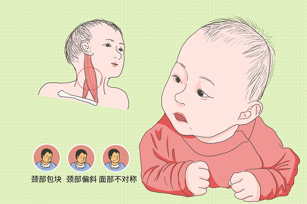 习惯性斜颈由于不良习惯引起颈部姿势不正引起多发生于婴儿