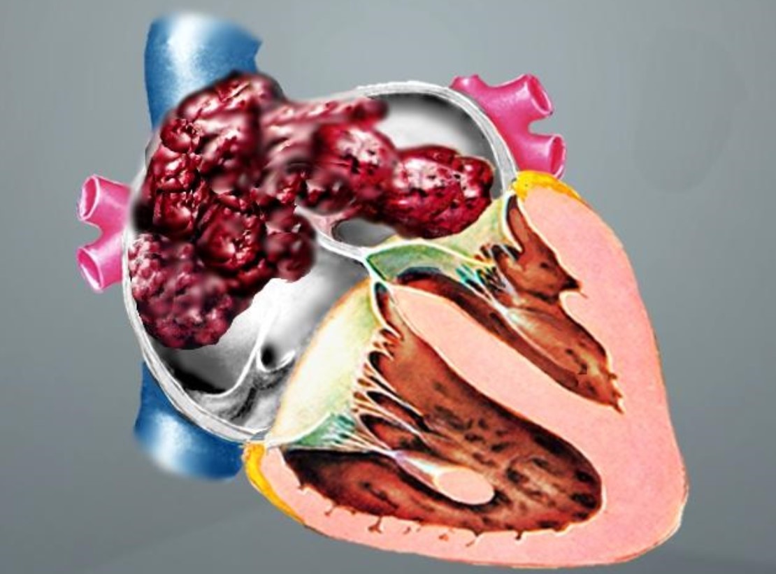心脏癌的图片图片