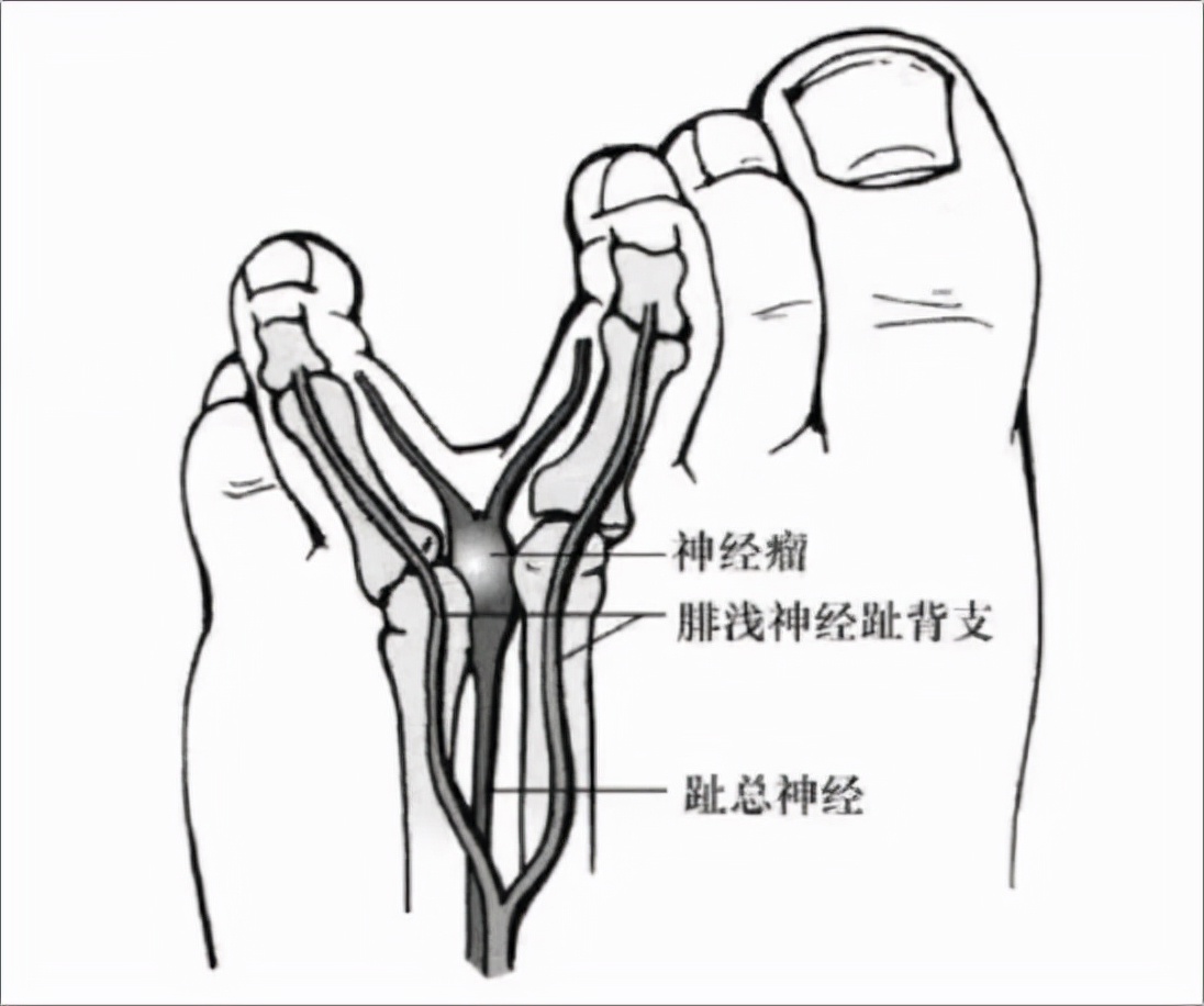 趾间神经瘤,亦称莫顿(morton)综合征,发病患者常见于女性