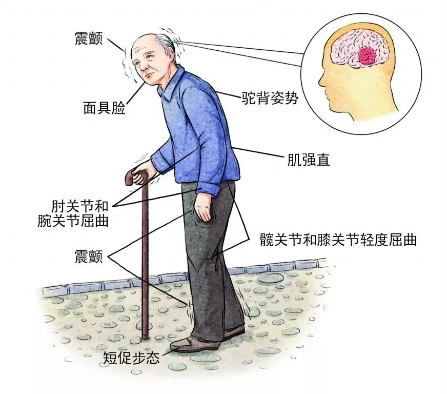 「世界帕金森病日:关爱帕金森患者,不再害"帕"