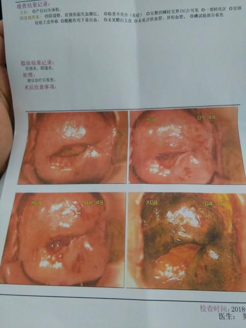 慢性宫颈炎的真实图片图片