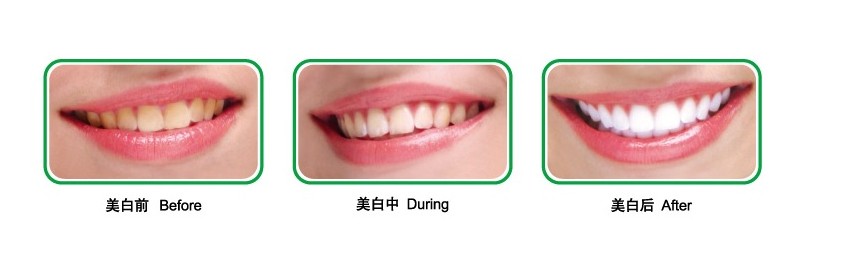 四环素牙如何美白?