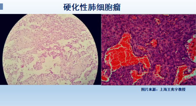 肺癌病理切片图图片