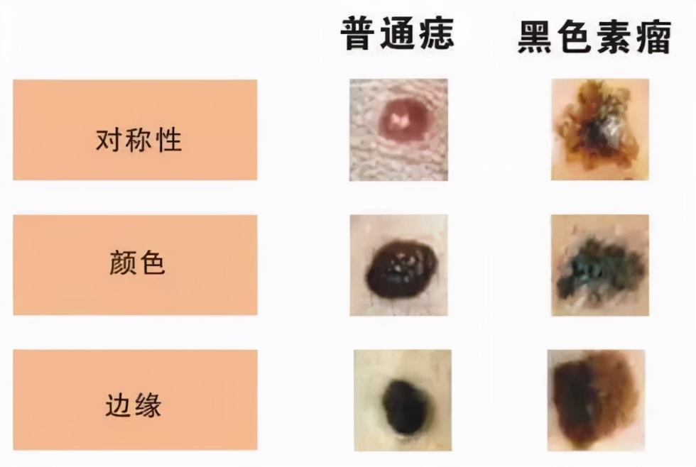 黑色素瘤都是恶性的吗图片