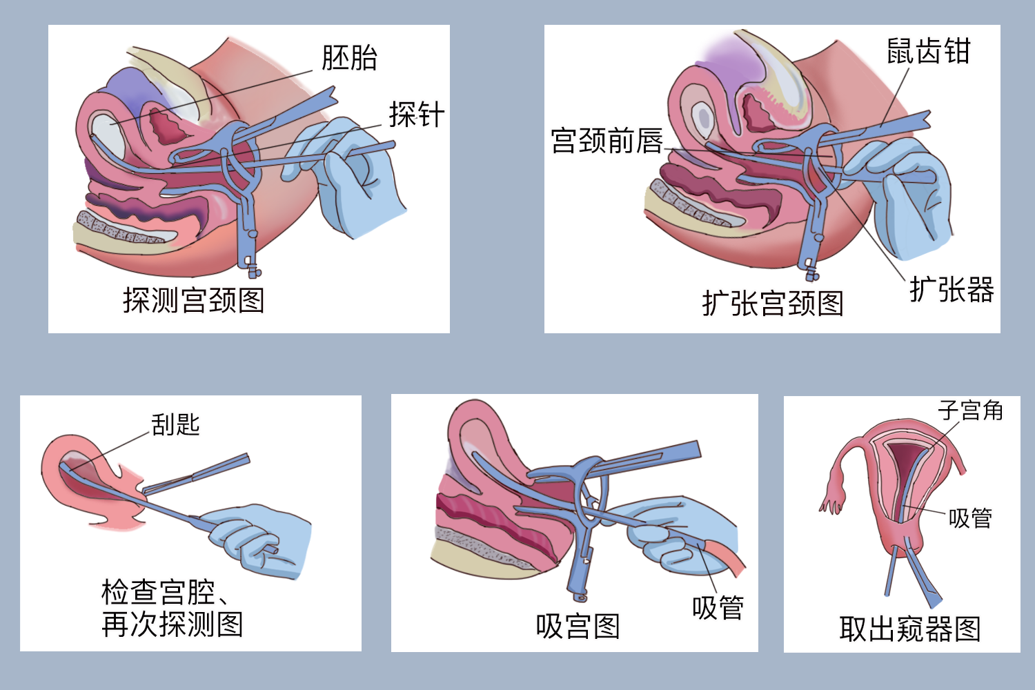 無痛人流步驟過程圖片,扎心了