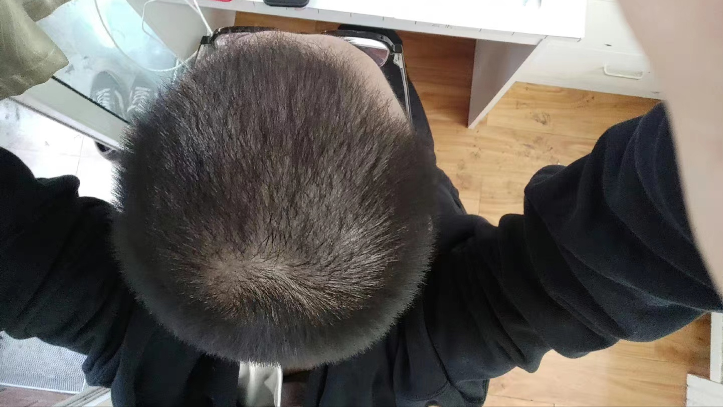 男生使用5%米诺地尔,三个月头发居然长了这么多?