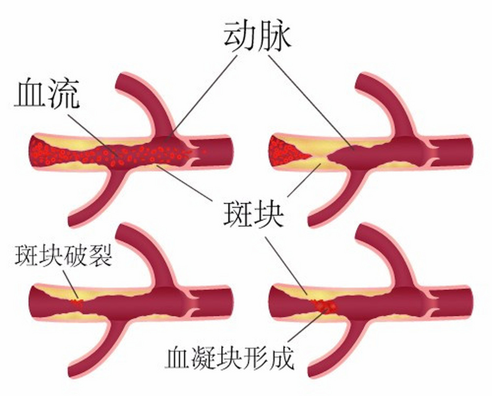 血管斑块图示图片