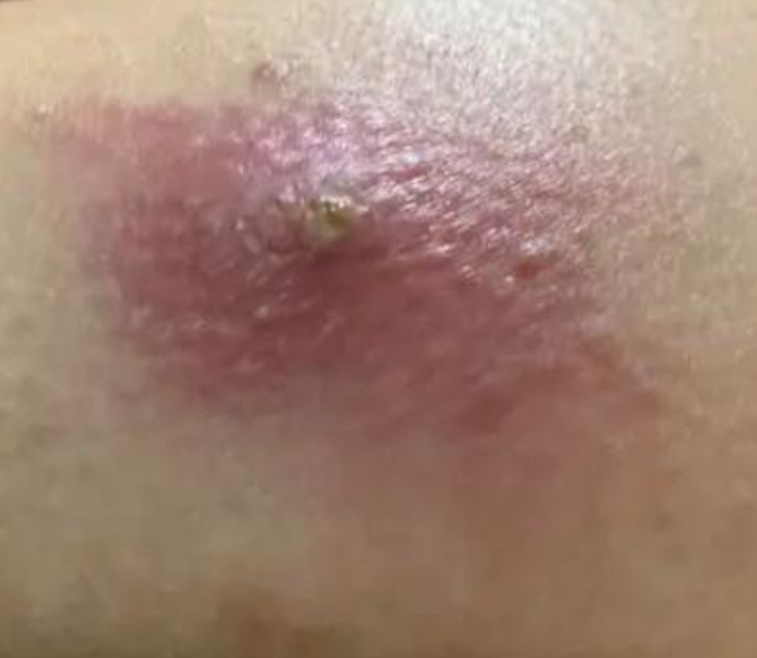 我妈背部长了个疙瘩,刚开始不痛不痒,后来去医院检查后医生说是粉瘤