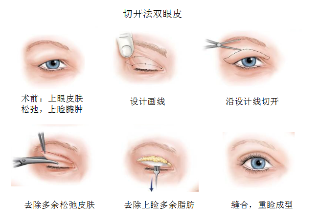 割双眼皮有哪些风险图片