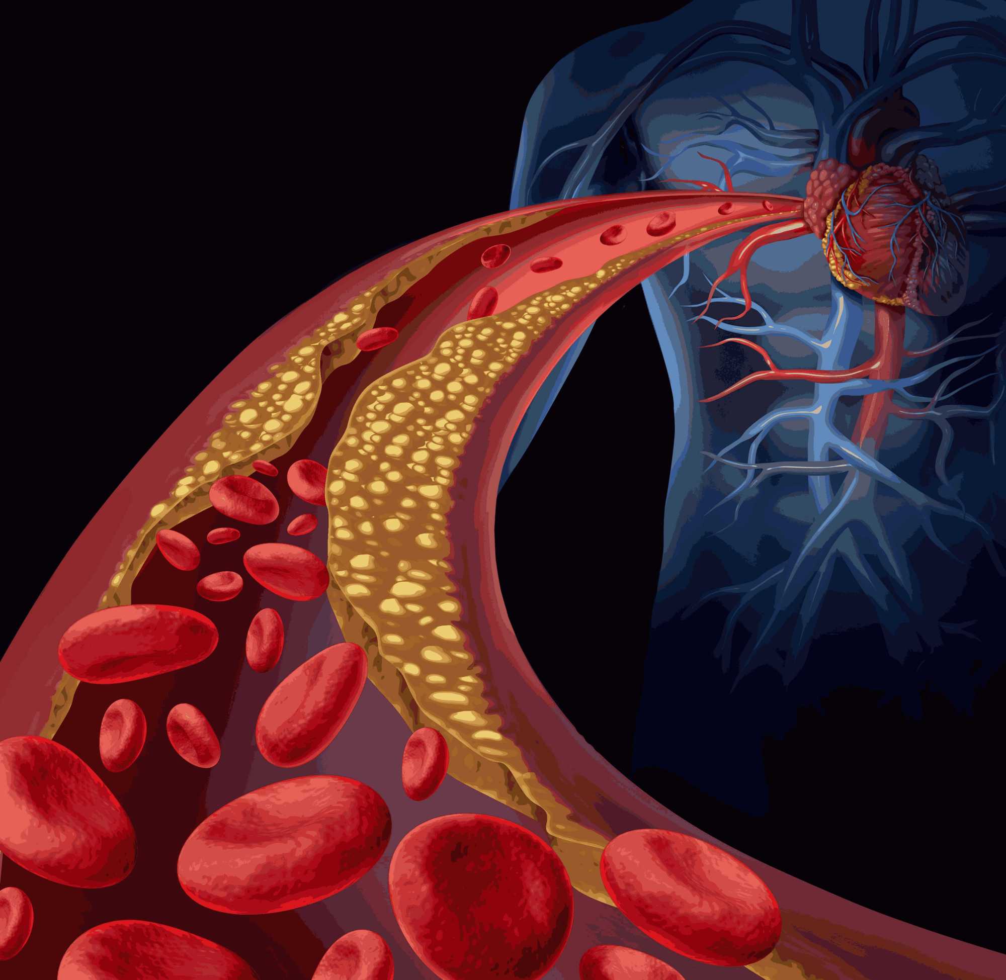 冠状动脉扩张病,罕见且具有遗传性质,患病人士中男性比较多