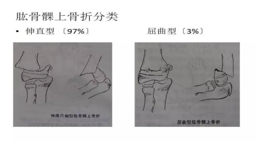 肱骨髁上骨折是哪里图片