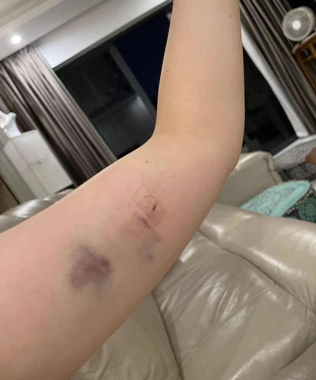 为了避孕,我在胳膊里埋了1根针