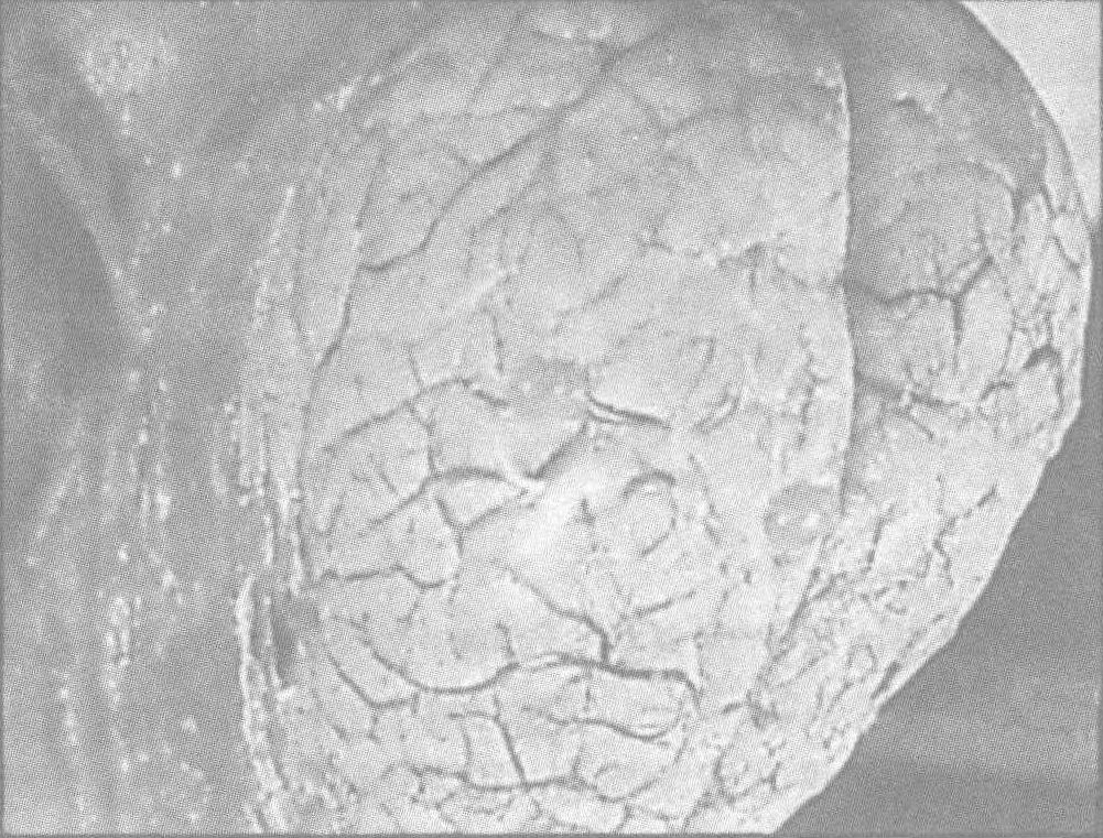 骨包囊虫病主要是寄生虫引起,该病多发生在畜牧区,较难发现患病