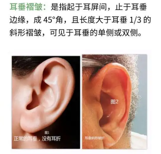 耳朵有褶,法令纹是心脏病的"标志"?医生:不能盲目划等号