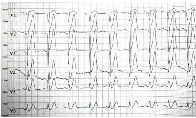 t波高尖心电图表现图片