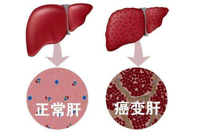 肝癌到了晚期坚持治疗有用吗医生坦言试试这5种治疗方法