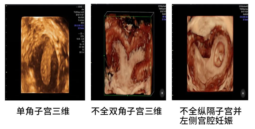 纵膈子宫三维彩超图片图片