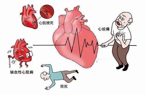 心梗发作前有哪些征兆大家一定要引起重视早了解早受益