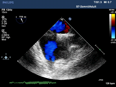 技术导航|心脏超声检查新视窗——经食管超声心动图检查