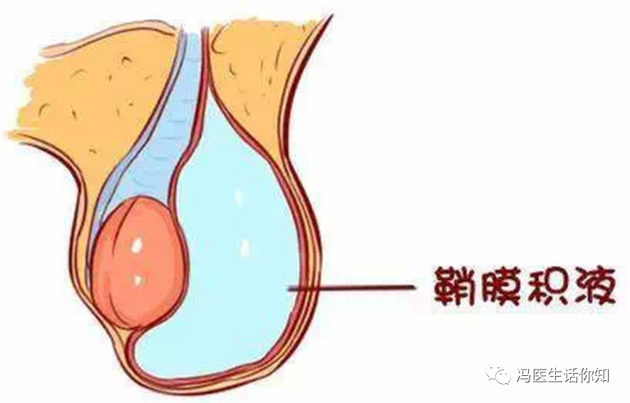 "水疝"是疝气吗?